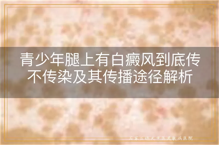 青少年腿上有白癜风到底传不传染及其传播途径解析
