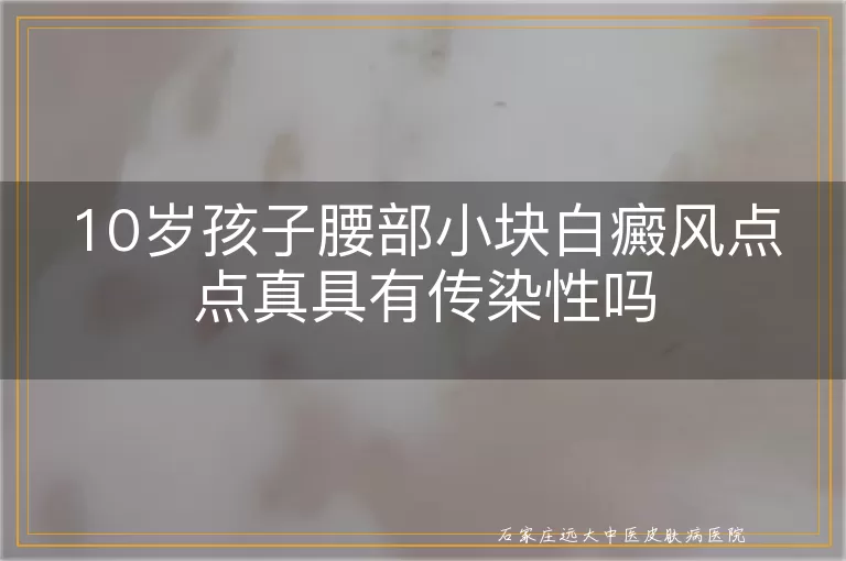 10岁孩子腰部小块白癜风点点真具有传染性吗