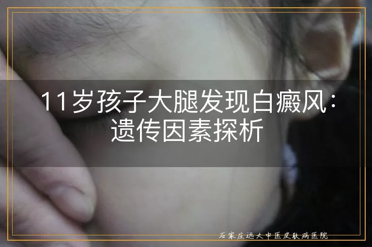 11岁孩子大腿发现白癜风：遗传因素探析