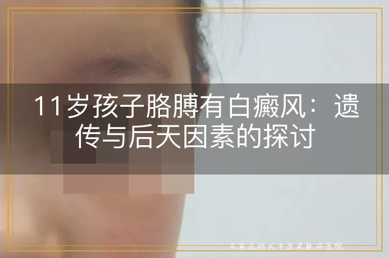 11岁孩子胳膊有白癜风：遗传与后天因素的探讨