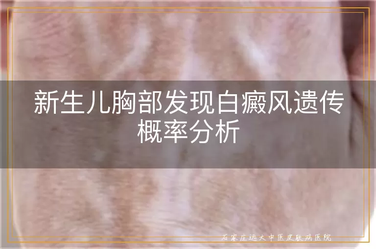 新生儿胸部发现白癜风遗传概率分析