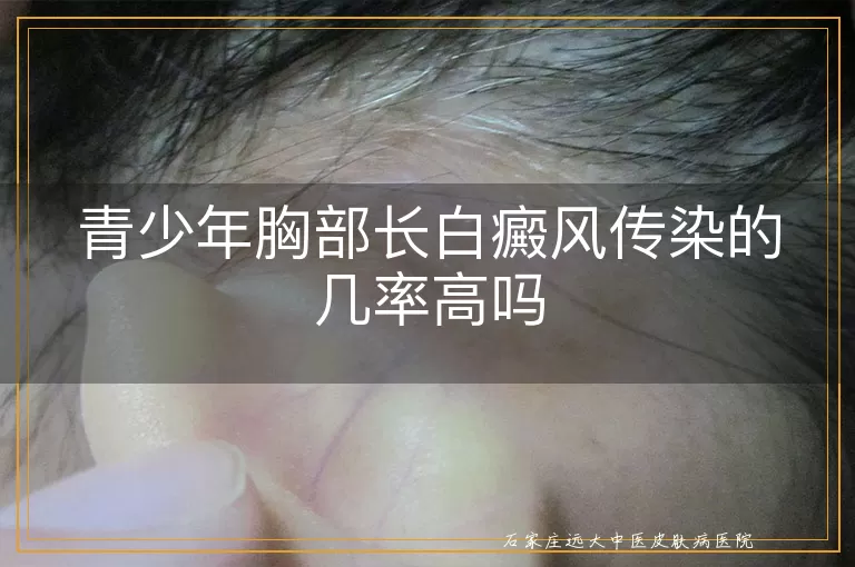 青少年胸部长白癜风传染的几率高吗