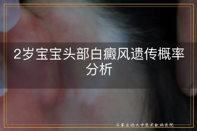 2岁宝宝头部白癜风遗传概率分析