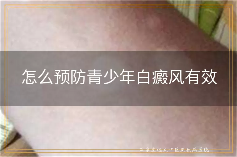 怎么预防青少年白癜风有效
