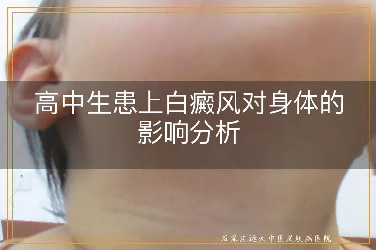 高中生患上白癜风对身体的影响分析
