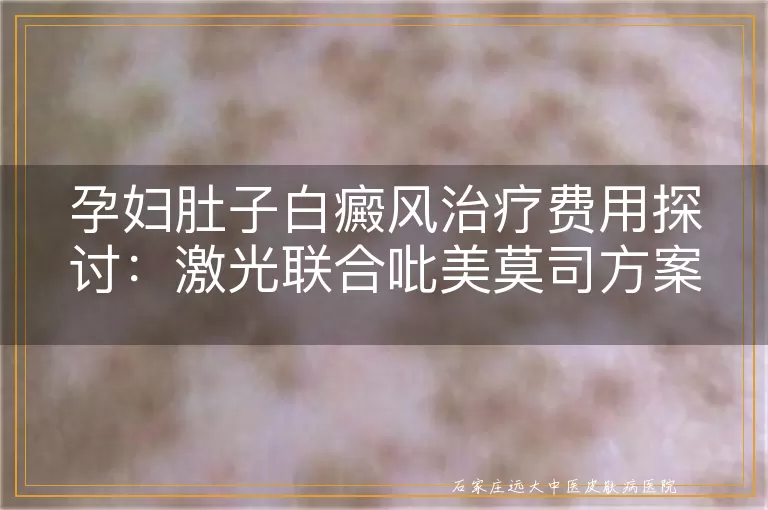 孕妇肚子白癜风治疗费用探讨：激光联合吡美莫司方案