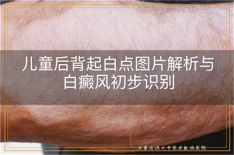 儿童后背起白点图片解析与白癜风初步识别