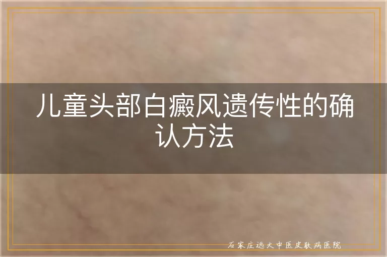 儿童头部白癜风遗传性的确认方法
