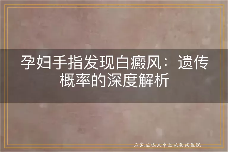 孕妇手指发现白癜风：遗传概率的深度解析