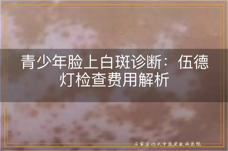 青少年脸上白斑诊断：伍德灯检查费用解析