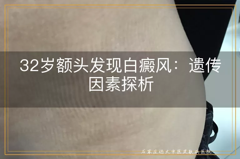 32岁额头发现白癜风：遗传因素探析