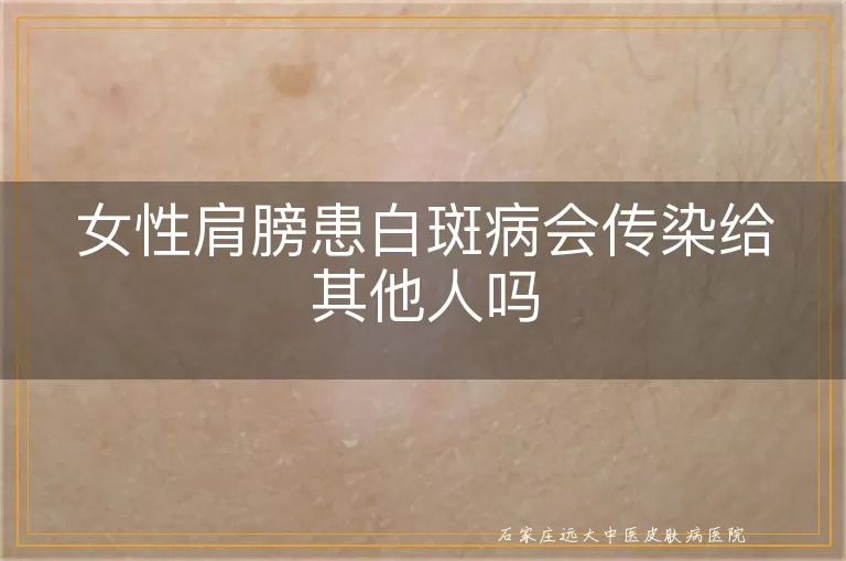 女性肩膀患白斑病会传染给其他人吗
