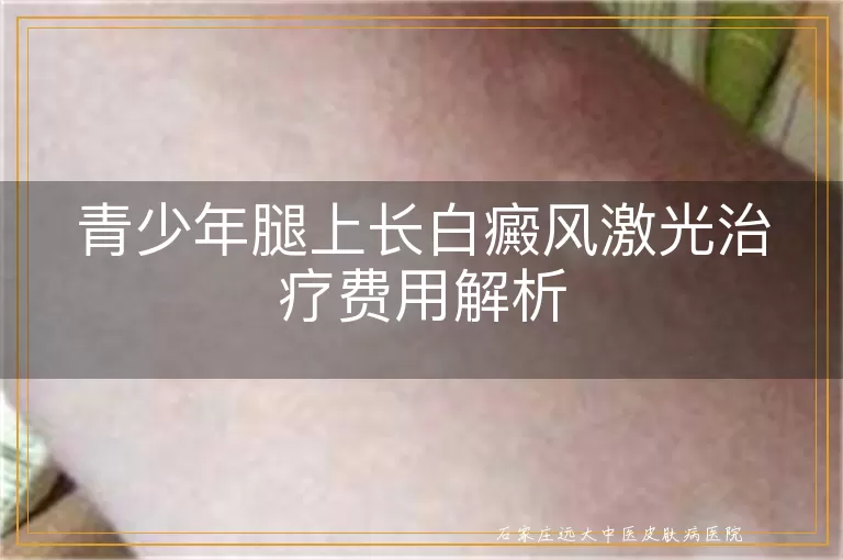 青少年腿上长白癜风激光治疗费用解析