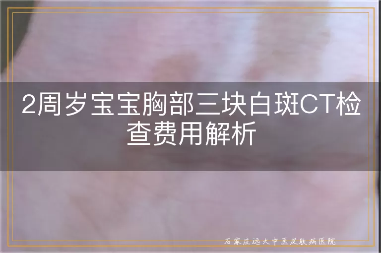 2周岁宝宝胸部三块白斑CT检查费用解析