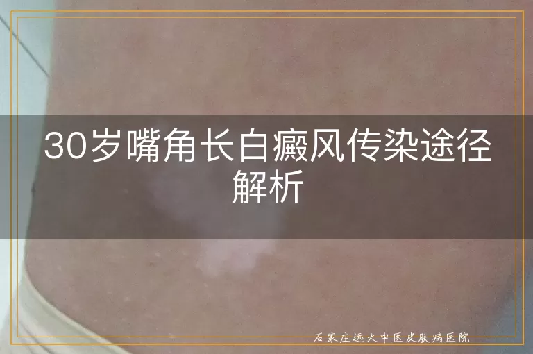 30岁嘴角长白癜风传染途径解析