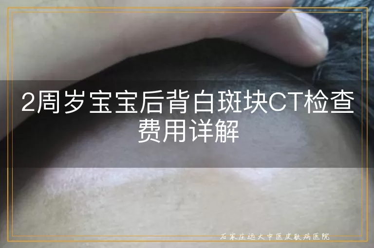 2周岁宝宝后背白斑块CT检查费用详解