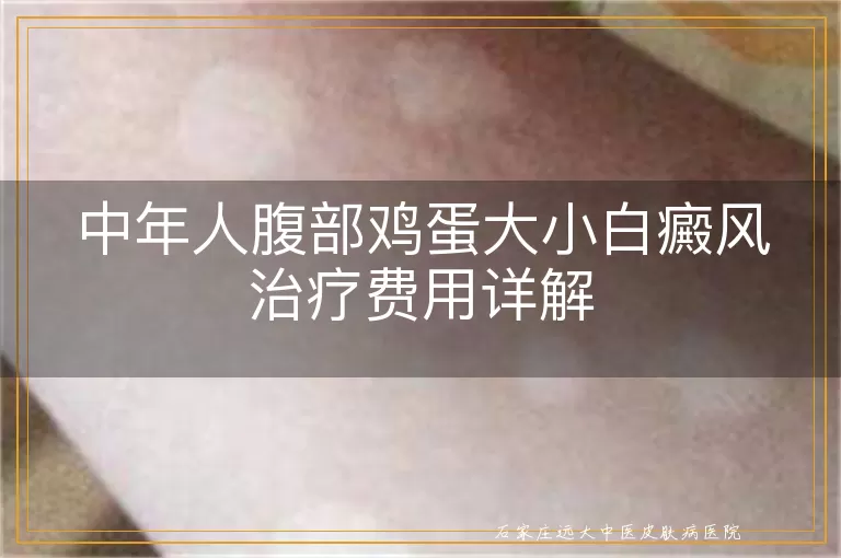 中年人腹部鸡蛋大小白癜风治疗费用详解