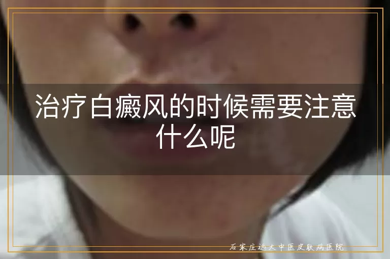 治疗白癜风的时候需要注意什么呢
