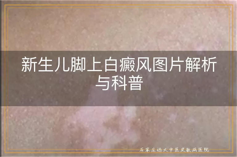 新生儿脚上白癜风图片解析与科普