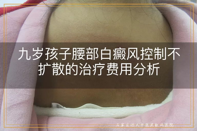 九岁孩子腰部白癜风控制不扩散的治疗费用分析