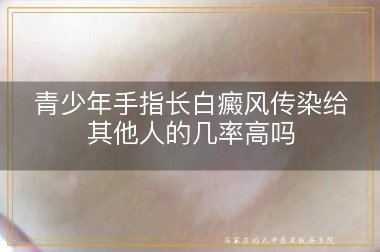 青少年手指长白癜风传染给其他人的几率高吗