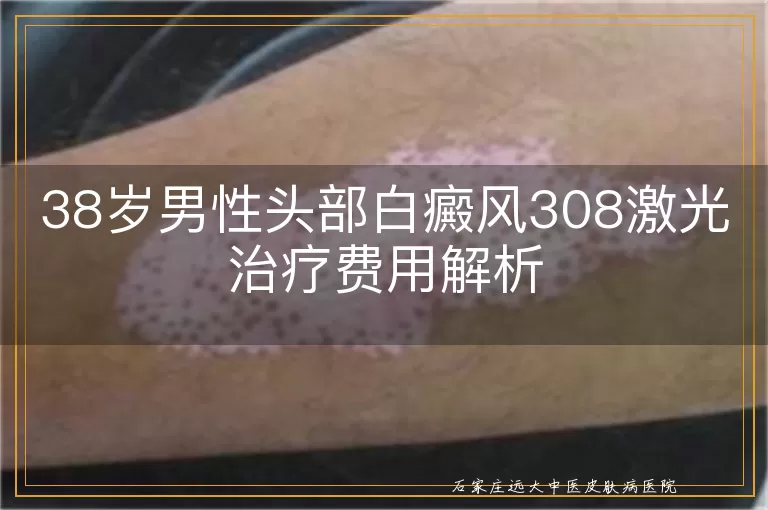 38岁男性头部白癜风308激光治疗费用解析