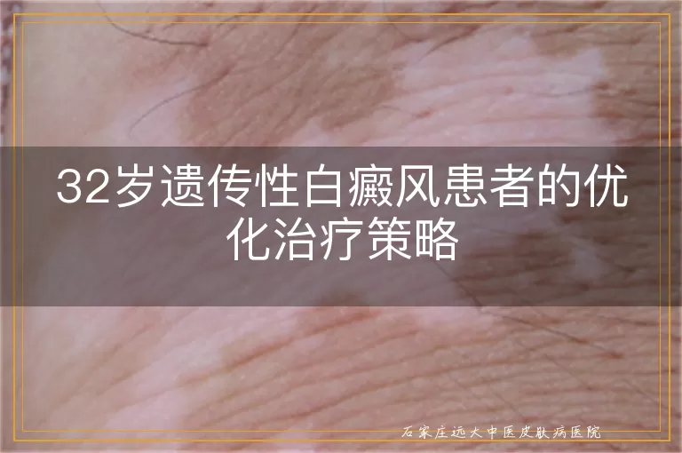 32岁遗传性白癜风患者的优化治疗策略