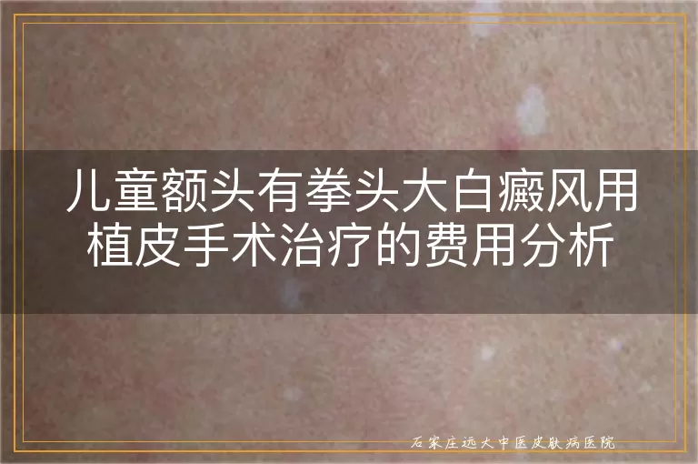 儿童额头有拳头大白癜风用植皮手术治疗的费用分析