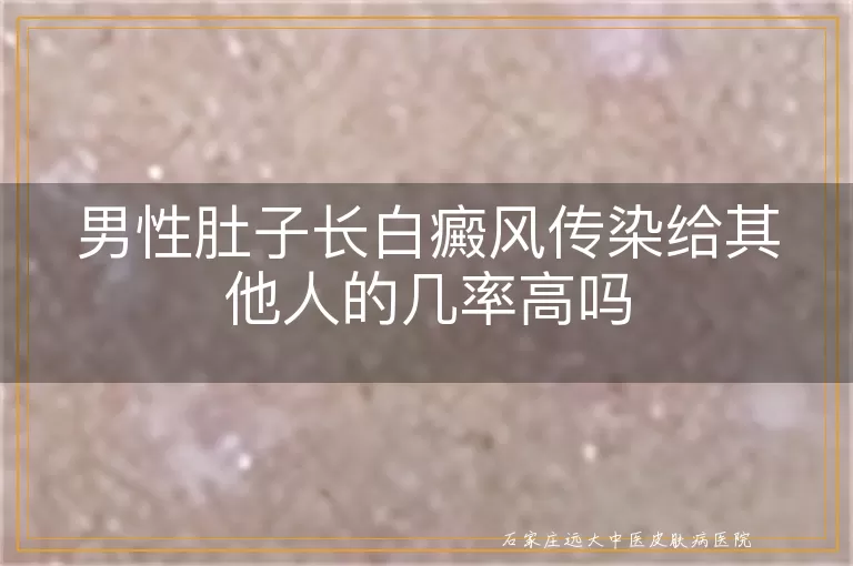 男性肚子长白癜风传染给其他人的几率高吗