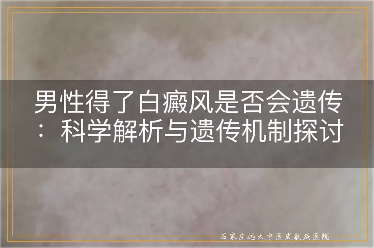 男性得了白癜风是否会遗传：科学解析与遗传机制探讨
