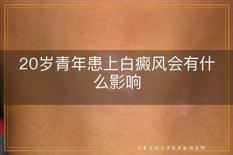 20岁青年患上白癜风会有什么影响