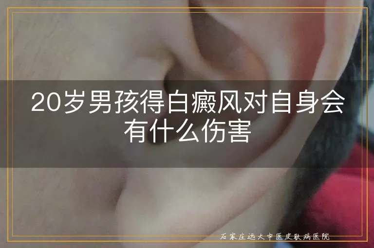 20岁男孩得白癜风对自身会有什么伤害