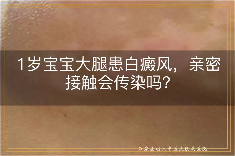 1岁宝宝大腿患白癜风，亲密接触会传染吗？