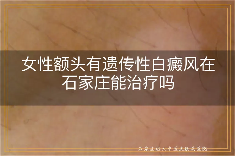 女性额头有遗传性白癜风在石家庄能治疗吗