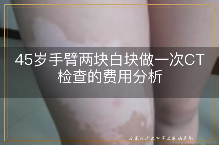 45岁手臂两块白块做一次CT检查的费用分析