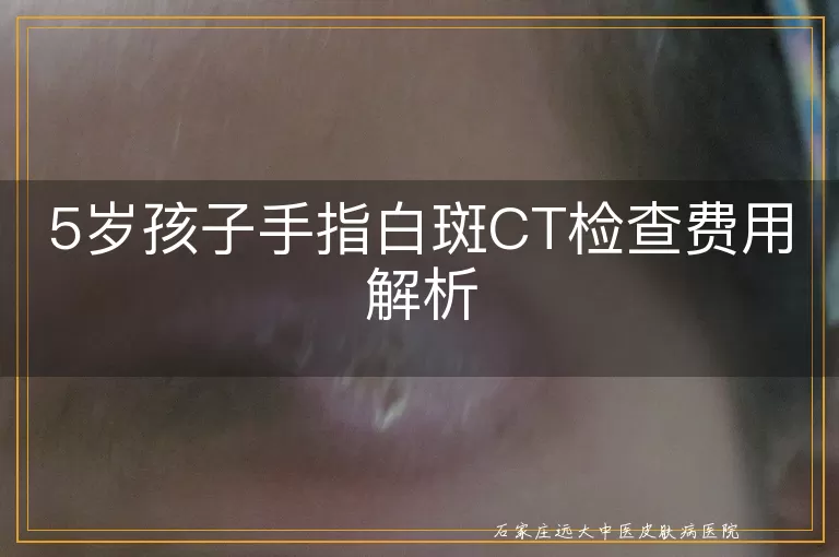 5岁孩子手指白斑CT检查费用解析