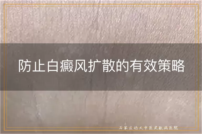 防止白癜风扩散的有效策略