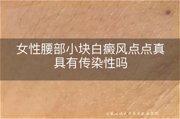 女性腰部小块白癜风点点真具有传染性吗