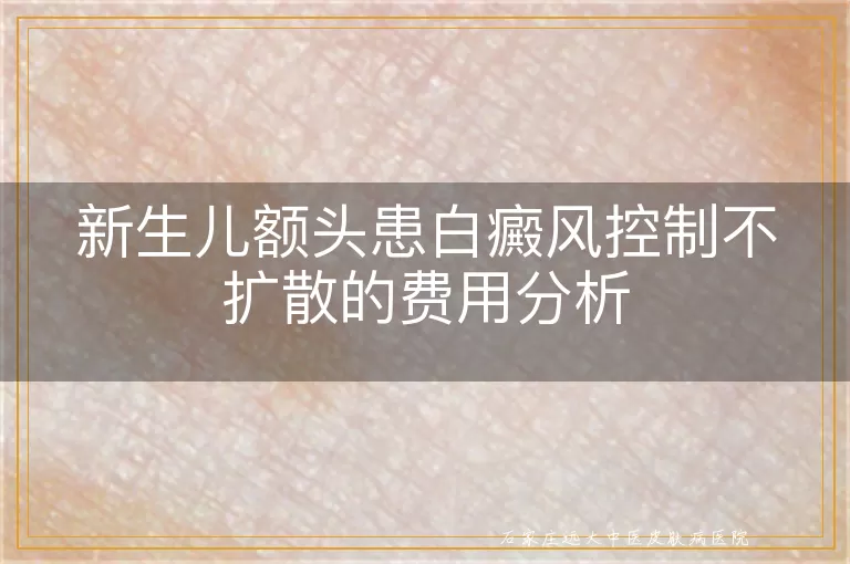 新生儿额头患白癜风控制不扩散的费用分析