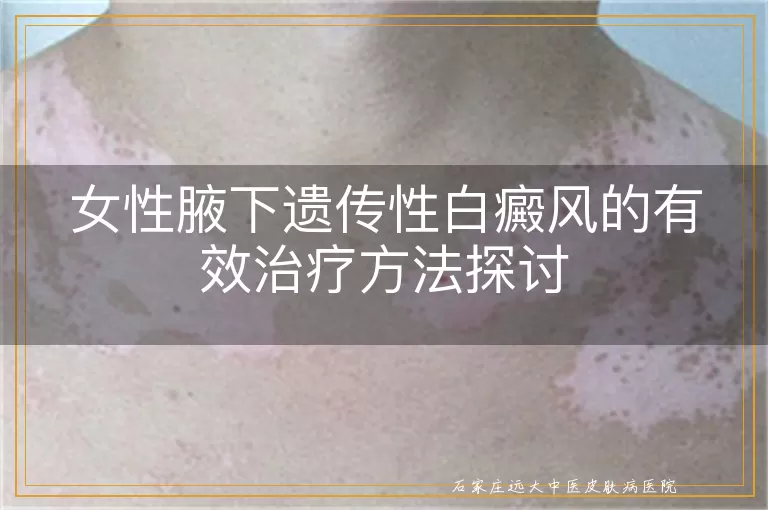 女性腋下遗传性白癜风的有效治疗方法探讨