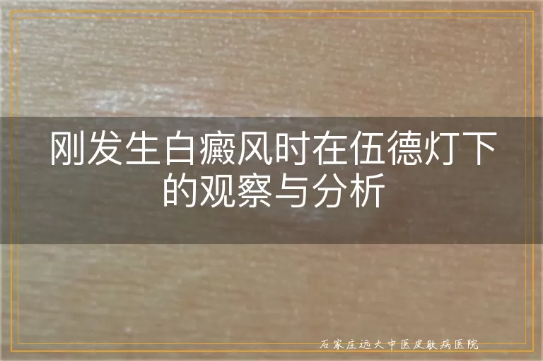 刚发生白癜风时在伍德灯下的观察与分析