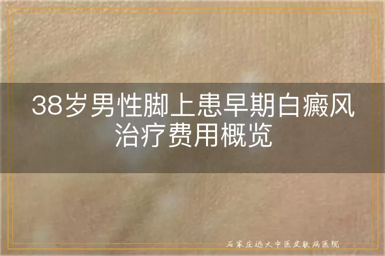 38岁男性脚上患早期白癜风治疗费用概览