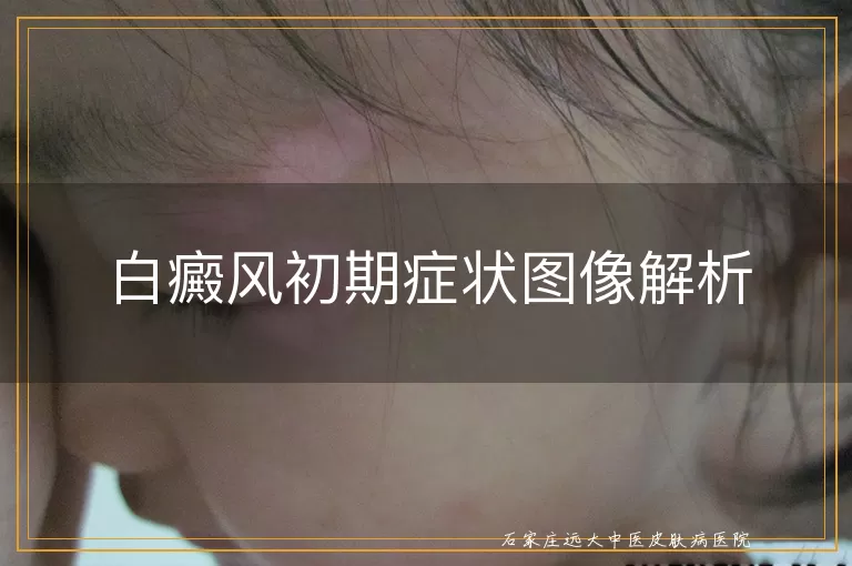 白癜风初期症状图像解析