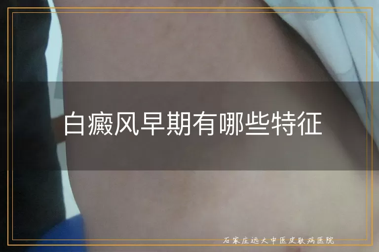 白癜风早期有哪些特征