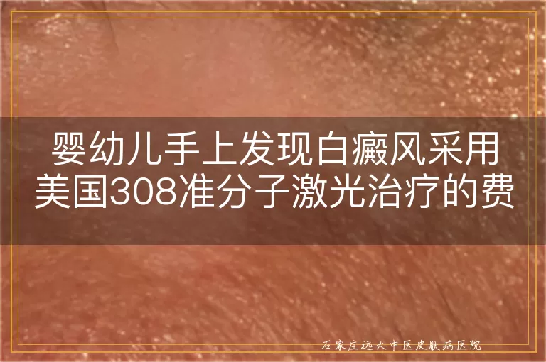 婴幼儿手上发现白癜风采用美国308准分子激光治疗的费用探讨
