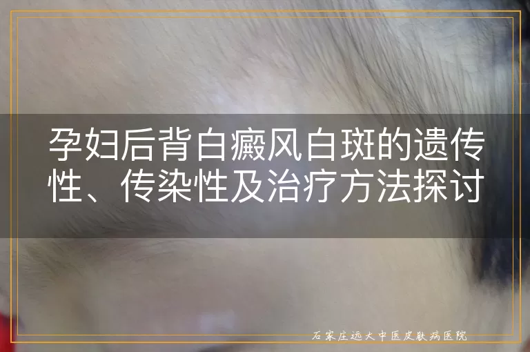 孕妇后背白癜风白斑的遗传性、传染性及治疗方法探讨