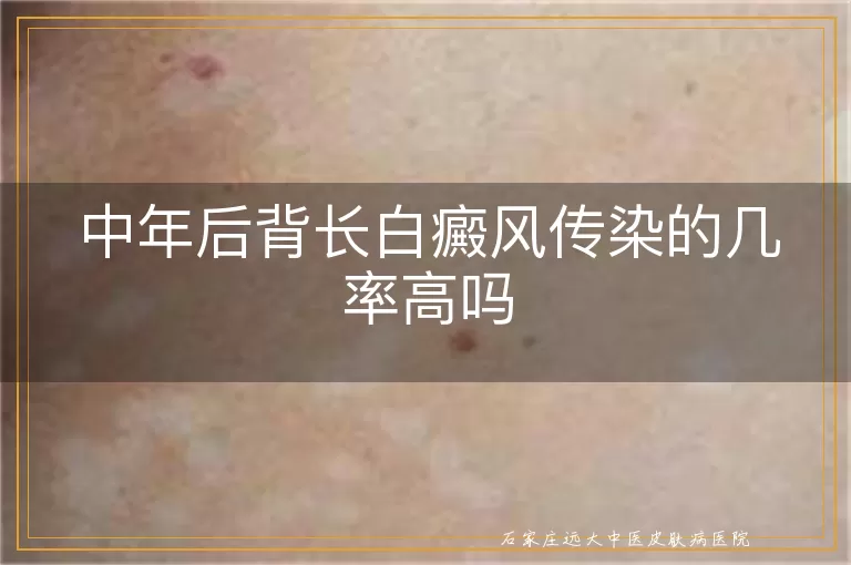 中年后背长白癜风传染的几率高吗