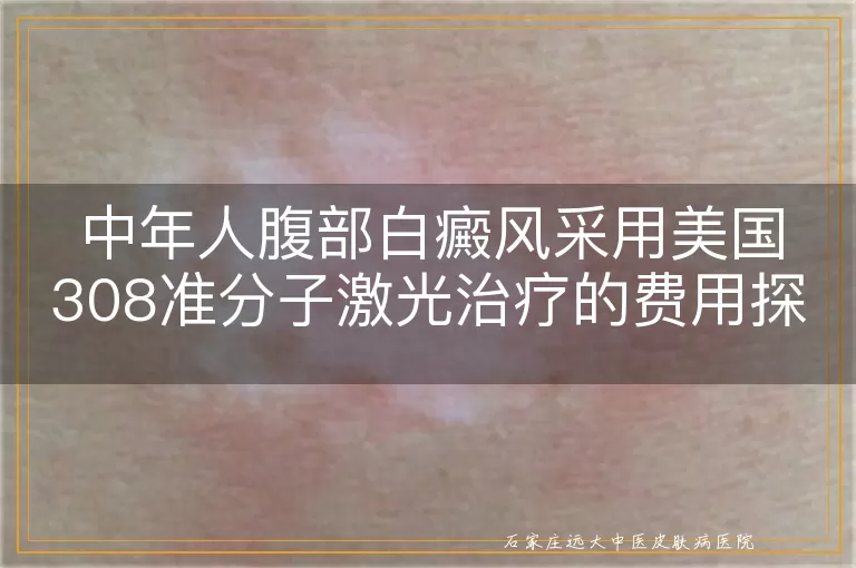 中年人腹部白癜风采用美国308准分子激光治疗的费用探讨