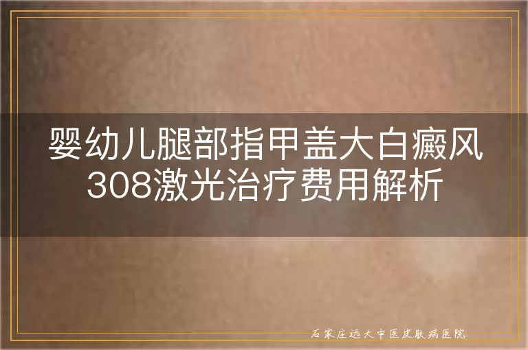 婴幼儿腿部指甲盖大白癜风308激光治疗费用解析
