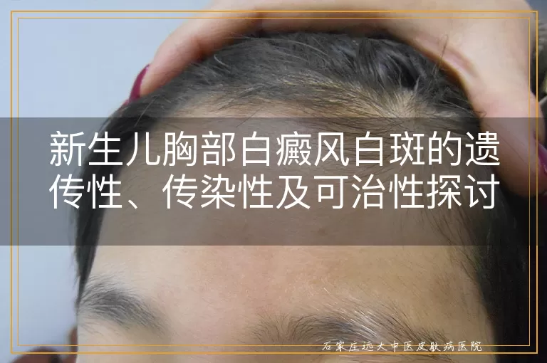 新生儿胸部白癜风白斑的遗传性、传染性及可治性探讨